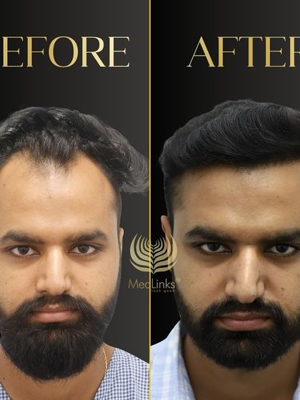 This before and after comparison shows a dramatic improvement in hair density and hairline. The patient looks younger and more confident.
