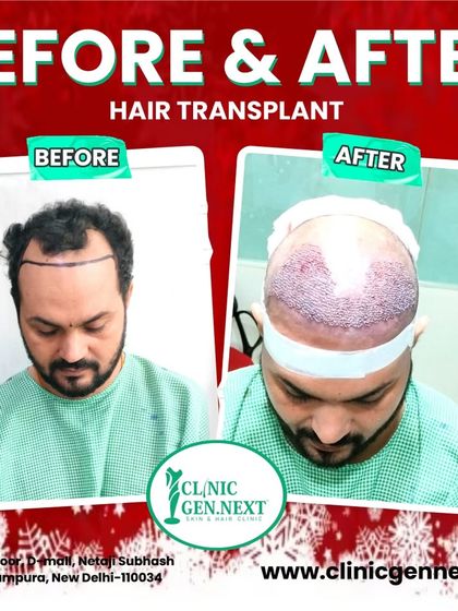 Another example of a before-and-after, showing the patient's thinning hair and the immediate post-op result with newly implanted grafts.