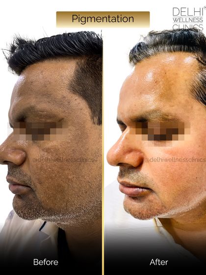 This side profile demonstrates the effectiveness of our pigmentation treatment in reducing dark patches and improving overall skin texture for a healthier appearance.