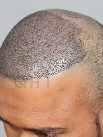 High-density, high-impact. 5000 grafts placed to restore the hairline and mid-scalp for a powerful comeback.
