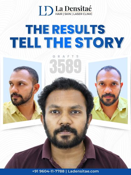 Precision is the foundation of every successful hair restoration. For this patient, 3,589 grafts were meticulously transplanted using my RT-FUE technique to achieve a hairline that is both dense and completely natural.