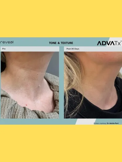 A different angle of the same neck treatment, confirming the consistent and impressive results in improving tone and texture.