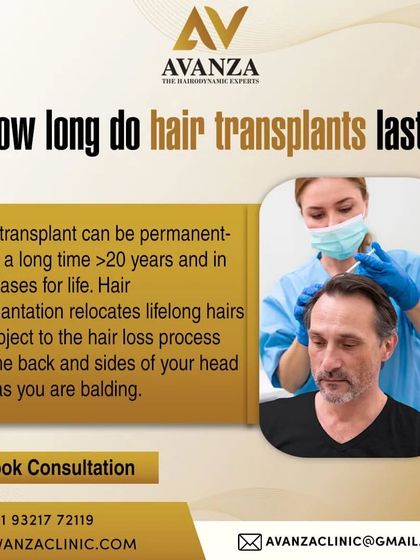 How long do hair transplants last? A transplant can be a permanent, lifelong solution. We relocate hair follicles that are not subject to the balding process, ensuring they last for decades.