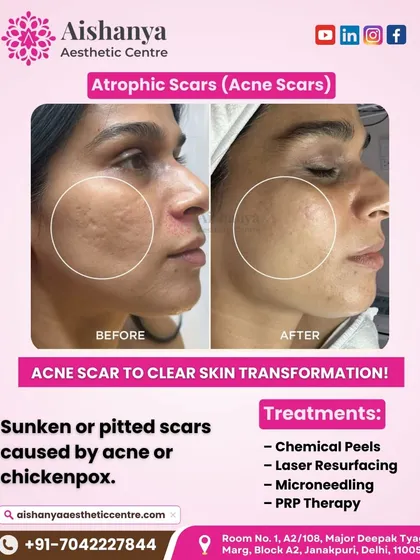 This client's journey shows the transformation from atrophic, or sunken, acne scars to much smoother skin. We used a combination of treatments like laser resurfacing and microneedling to achieve this result.