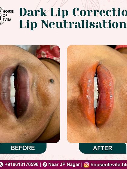 This before-and-after shows the process of Dark Lip Correction. The "after" shows the neutralizing pigment immediately after application, which will heal to a soft, natural tone.