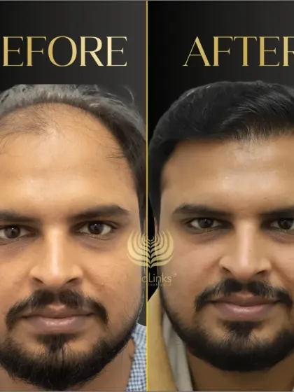 A fantastic before and after result. We focused on creating a dense, natural hairline that completely rejuvenates the patient's appearance.