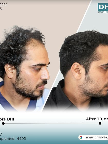 A side-profile view of the same client's 10-month transformation. The restored hairline and temple points create a sharp, defined look, showcasing the artistic precision of our DHI surgeons.