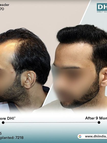 A side-profile view of the same client's 9-month transformation. The restored hairline and increased thickness are clearly visible, showcasing a natural and youthful result.