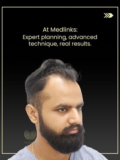 This was Jitendra before his procedure, dealing with thinning hair that affected his confidence.
