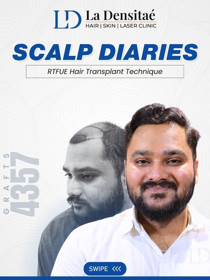 Abhijeet decided to find a solution that worked. With 4,357 grafts using the advanced RT-FUE technique, I didn't just restore his hairline, I restored the confidence he thought he had lost. Real transformation begins when you decide to act.