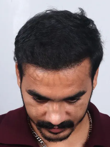 A complete 10-month transformation for a Diffuse Grade 5A case. We recreated the hairline and added density to the frontal and mid-scalp with 3,800 grafts.