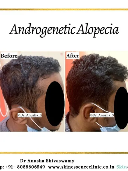 Here is a clear example of treating androgenetic alopecia, focusing on a receding hairline. The 'after' photo shows a noticeable restoration of the hairline and increased thickness in the temple area, achieved through a personalized treatment plan.