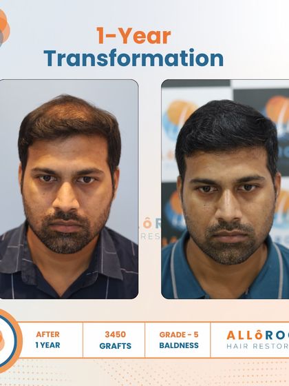 This is a one-year transformation for a Grade 5 baldness case, achieved with 3450 grafts. The before and after photos from various angles show a comprehensive restoration of the scalp, resulting in a full and natural look.