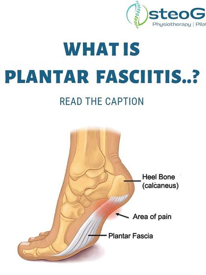 Plantar Fasciitis is a primary cause of heel pain, involving inflammation of the tissue band on the bottom of your foot. This diagram clearly shows the plantar fascia and the typical area of pain.