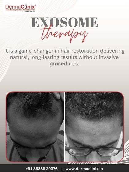 This before-and-after image shows the results of Exosome therapy, a game-changer in hair restoration that delivers natural, long-lasting results without invasive procedures.