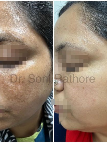 Another successful melasma result achieved through a combination of prescription creams, chemical peels, and laser sessions. The patient's commitment to daily sun protection was also a critical factor in her success.