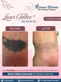 Tattoo & Mole Removal