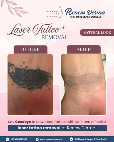 Tattoo & Mole Removal