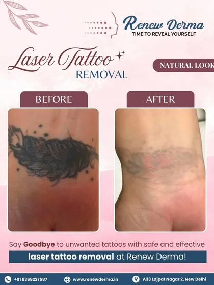 Here is a clear before and after of a laser tattoo removal on the wrist after a few sessions. The process gradually fades the ink, leaving behind clearer skin. Patience and consistency are key to getting the best results.