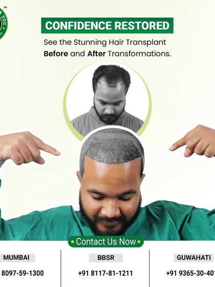 Confidence restored! This graphic showcases the stunning transformation possible with a hair transplant, with a client proudly pointing to his new, full head of hair.