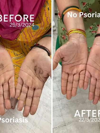 This is why I do what I do. This is my own mother's hand, before and after two months of following a Yogic and Ayurvedic lifestyle I designed for her. She suffered from Psoriasis for years with no relief from modern medicine, but with consistent, natural practice, we healed it completely. This is the power of real yoga.