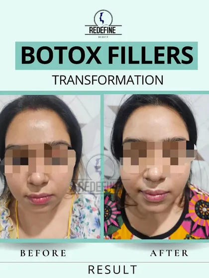 This client was looking for overall facial rejuvenation. By using a combination of Botox and dermal fillers, I was able to soften lines and restore volume, resulting in a fresher, more rested appearance. This is a perfect example of a non-surgical transformation.