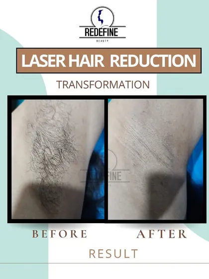 Forget the daily hassle of shaving your underarms. This before and after image shows the clear, smooth skin you can achieve with our painless laser hair reduction, eliminating both hair and the risk of ingrowns.