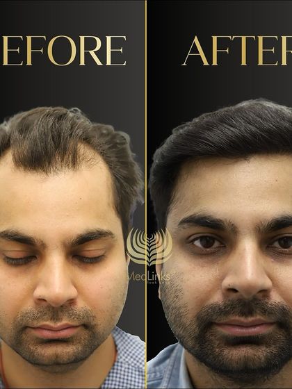 This before and after shot shows a significant improvement in hair density and hairline, resulting in a more confident and youthful appearance.