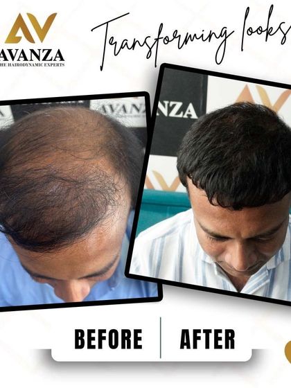 This transformation is a testament to the power of hair restoration. We restored full coverage to the top of his scalp, completely changing his look and boosting his confidence.