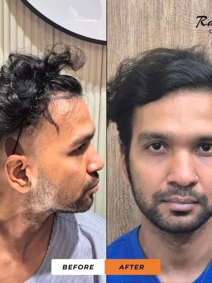 This patient, who shared his story in video 32, wanted a concealed transplant. This before-and-after shows the side view, highlighting the restored hairline without any signs of surgery.