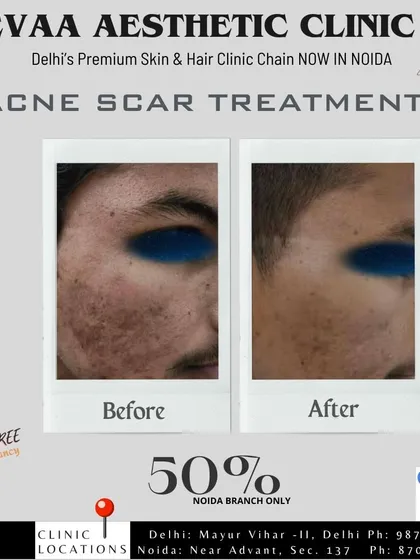 A before and after of our acne scar treatment, accompanied by a 50% off promotion for our Noida branch.