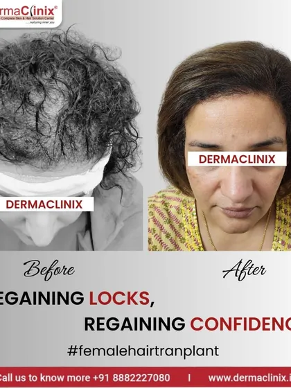 This before and after image showcases a successful hair transplant for a female patient. Using the Long Hair FUE technique, we can address hair thinning in women without shaving the head, helping them regain their locks and confidence discreetly.