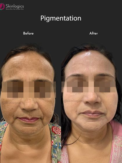This before and after image focuses on treating pigmentation on the forehead and cheeks. The 'after' photo shows a significant reduction in hyperpigmentation, leading to a more uniform and youthful skin appearance.