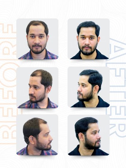 Mr. Chiranjibi decided it was time to fix his hair loss, and this multi-angle view shows the success of that decision. Using the RT-FUE technique, 2,767 grafts restored his natural hairline and density, proving hair loss is optional.