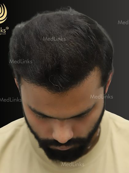 The top-down after shot, demonstrating the full coverage and natural density we achieved.