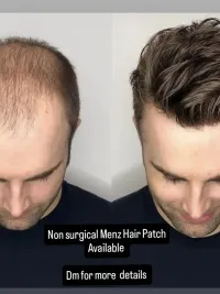 Non-Surgical Hair Replacement Systems