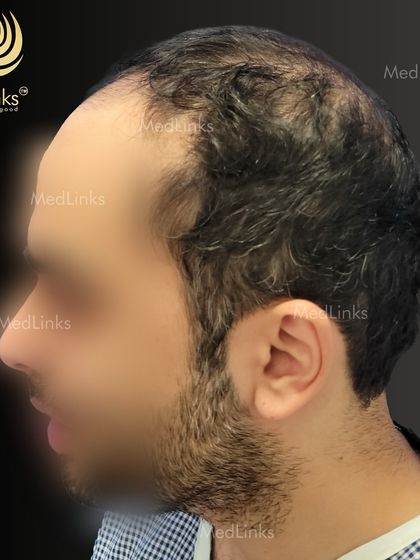 Another 'before' angle showing the extent of the hair loss.