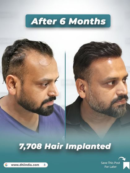 A side-profile view of Gaurav's 6-month progress. After implanting 7,708 hairs, his hairline is stronger and the density has dramatically improved, demonstrating the effectiveness of our doctor-led hair transplant procedure.