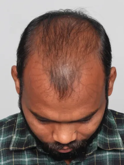 The end of Diffuse Grade 6 baldness. With a 5000-graft hair transplant, we achieved full coverage for the frontal hairline, mid-scalp, and crown.