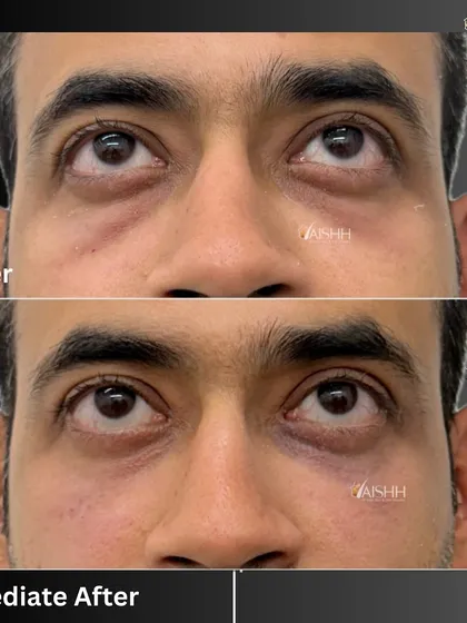 Under-eye hollows can make you look tired regardless of how much you rest. With just 1 ml of hyaluronic acid filler, we were able to instantly correct the volume loss in the tear trough area, resulting in a brighter and more youthful look.