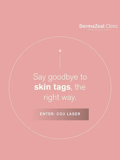 Say goodbye to skin tags the right way with CO2 laser treatment. It's a professional and precise method that avoids the risks and scarring associated with at-home removal attempts.