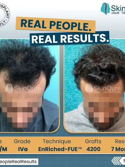 A 23-year-old patient with advanced Grade IVa hair loss. We used 4200 grafts to address the extensive balding area. The 7-month result shows a life-changing transformation with a full, dense, and natural-looking head of hair.