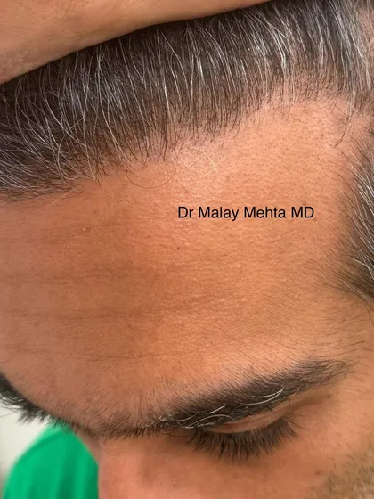 The secret to an undetectable hair transplant lies in the hairline. I never create harsh, straight lines. Instead, I design a soft, irregular hairline using a mix of single hair follicles, which perfectly mimics nature. This close-up shows the result of that artistic approach.