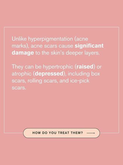 This graphic explains the difference between acne marks and acne scars. Scars involve significant damage to the skin's deeper layers and can be raised or depressed.