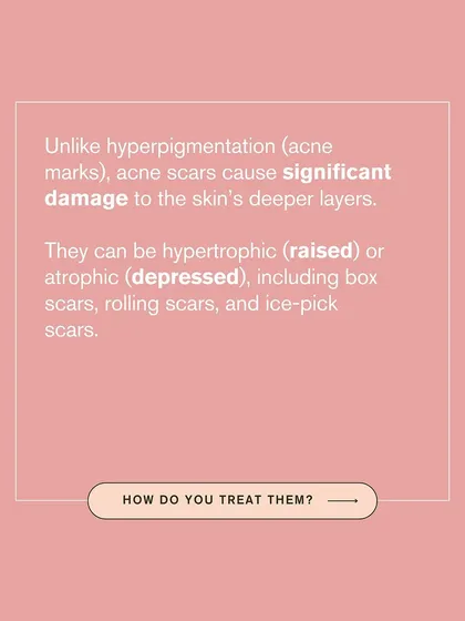 This graphic explains the difference between acne marks and acne scars. Scars involve significant damage to the skin's deeper layers and can be raised or depressed.
