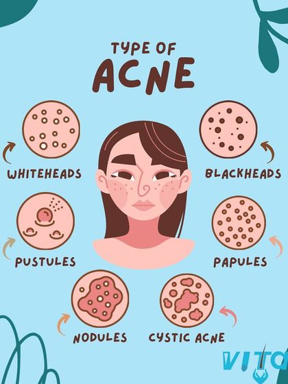 Vitals Klinic - Aesthetic Dermatology Acne & Scar Solutions photo 9