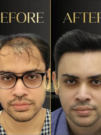 A great before and after transformation. The patient's new hair looks natural, dense, and has completely revitalized his appearance.