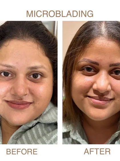 The power of a perfect brow. This before and after showcases our microblading service, where we create natural, symmetrical, and fuller-looking eyebrows that frame the face perfectly.