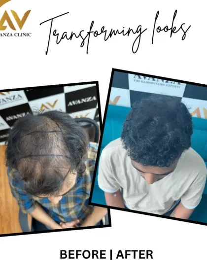 This image highlights the pre-operative markings for hairline restoration and the impressive final result. We successfully addressed both the receding hairline and thinning on top.