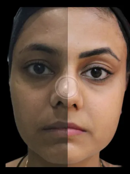 A closer look at the transformation journey for this patient. By focusing on hydration and pigmentation, we achieved a significant improvement in her overall skin health and radiance.